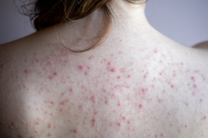 Effective Ways to Get Rid of Chest Acne: Proven Strategies for 2025