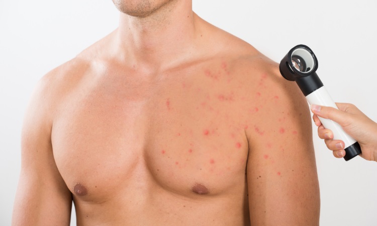 How to get rid of chest acne