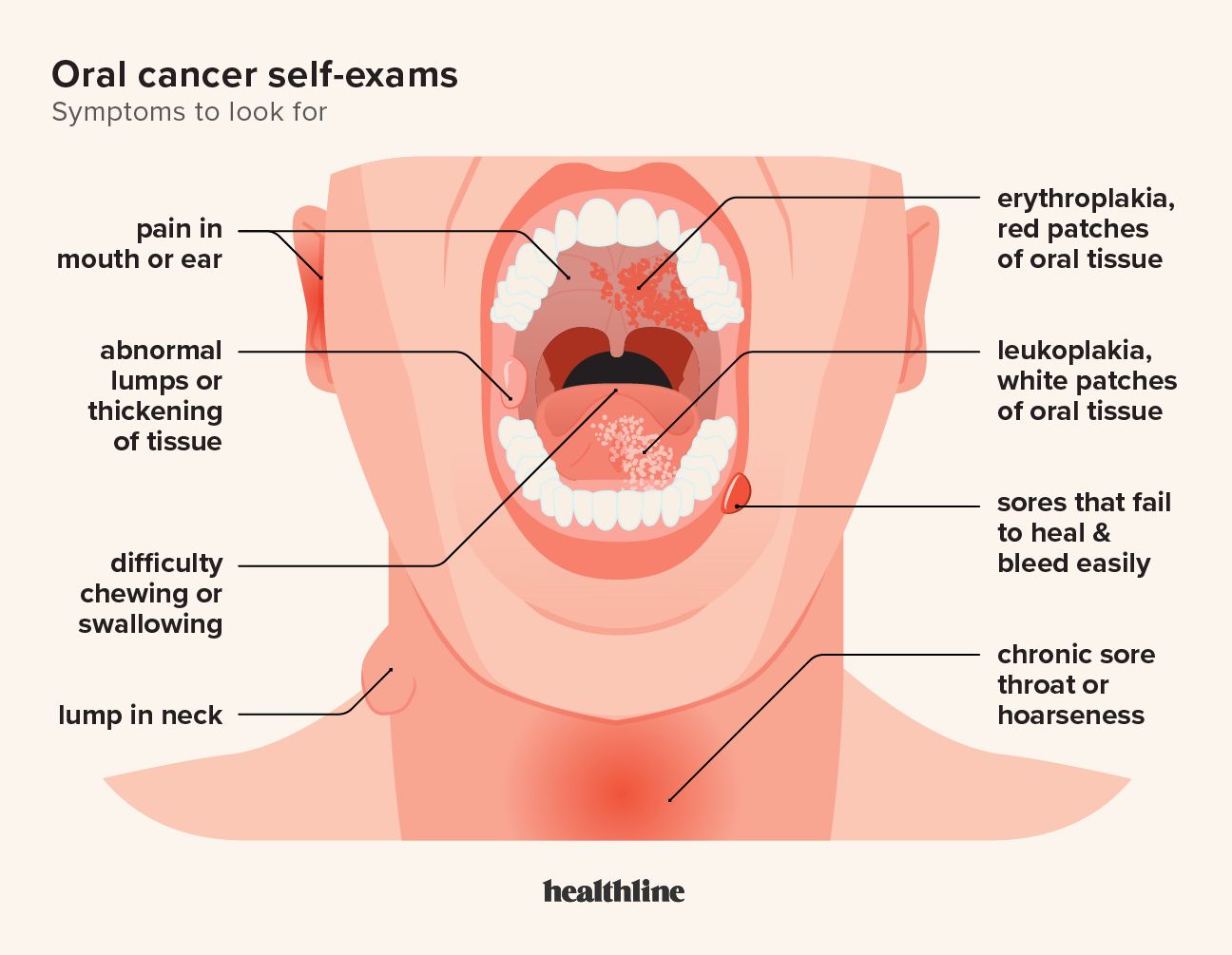 Essential Guide to How to Check for Throat Cancer at Home in 2025 – Discover Early Signs!