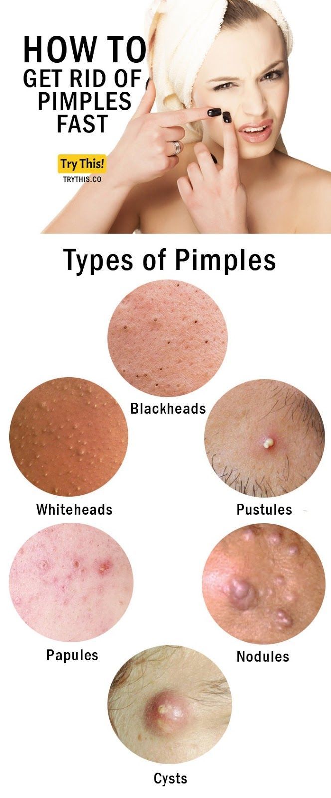 Effective Ways to Remove Pimples Overnight: Proven Solutions for Clear Skin in 2025