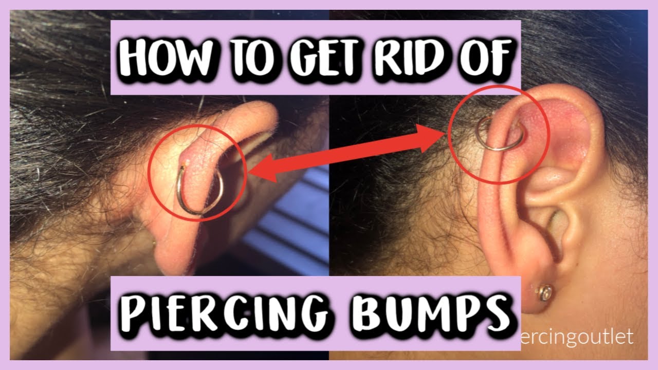 How to Effectively Get Rid of Piercing Bump for Smooth Skin in 2025