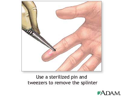 How to Effectively Get a Splinter Out: Smart Techniques for 2025