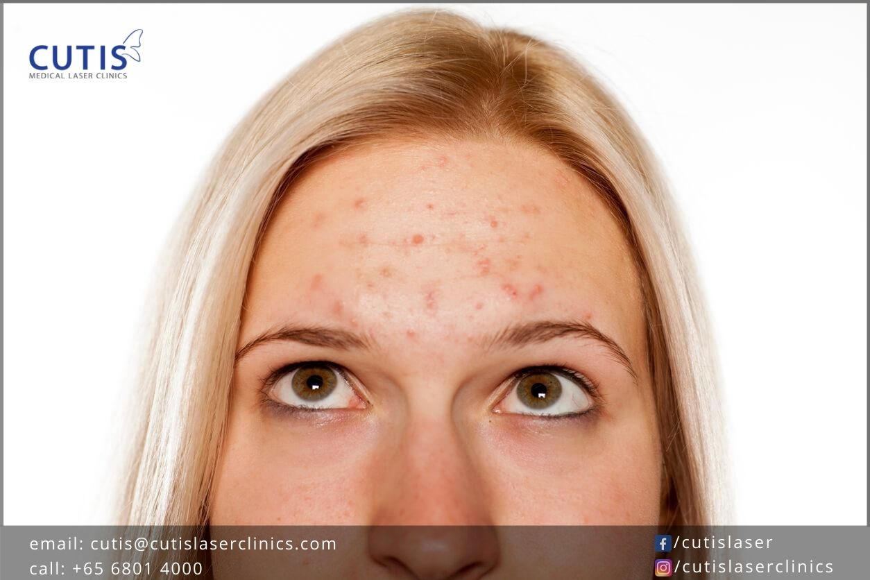 Effective Ways to Get Rid of Forehead Acne: Proven Tips for 2025