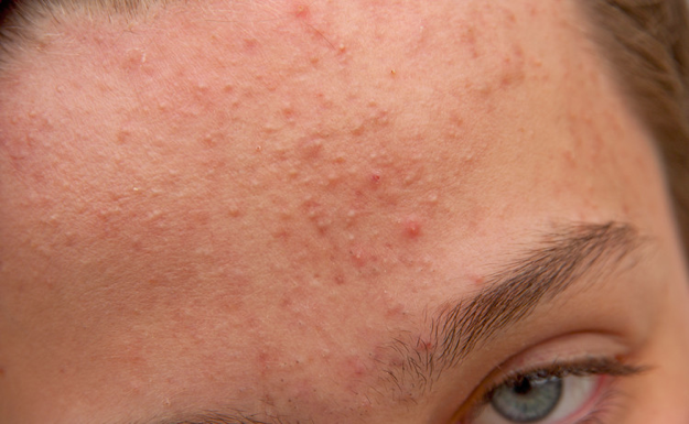 How to Get Rid of Forehead Acne