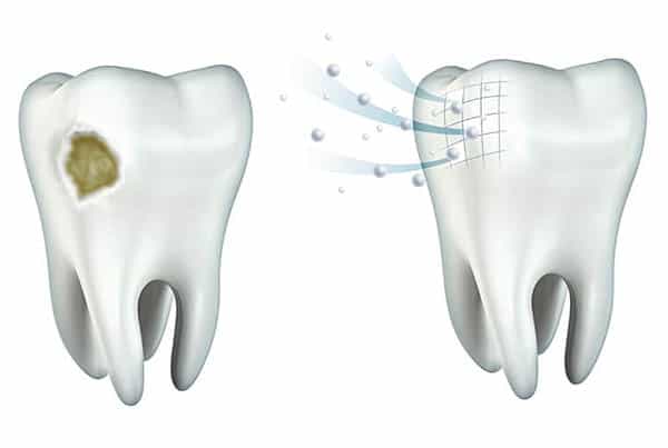 How to Effectively Remineralize Teeth This 2025: Proven Tips and Methods to Strengthen Enamel