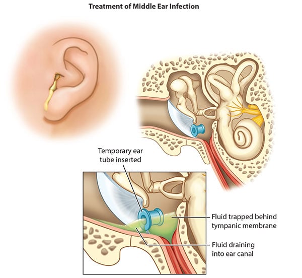 How to Effectively Drain Ear Fluid: Proven Methods for Quick Relief in 2025