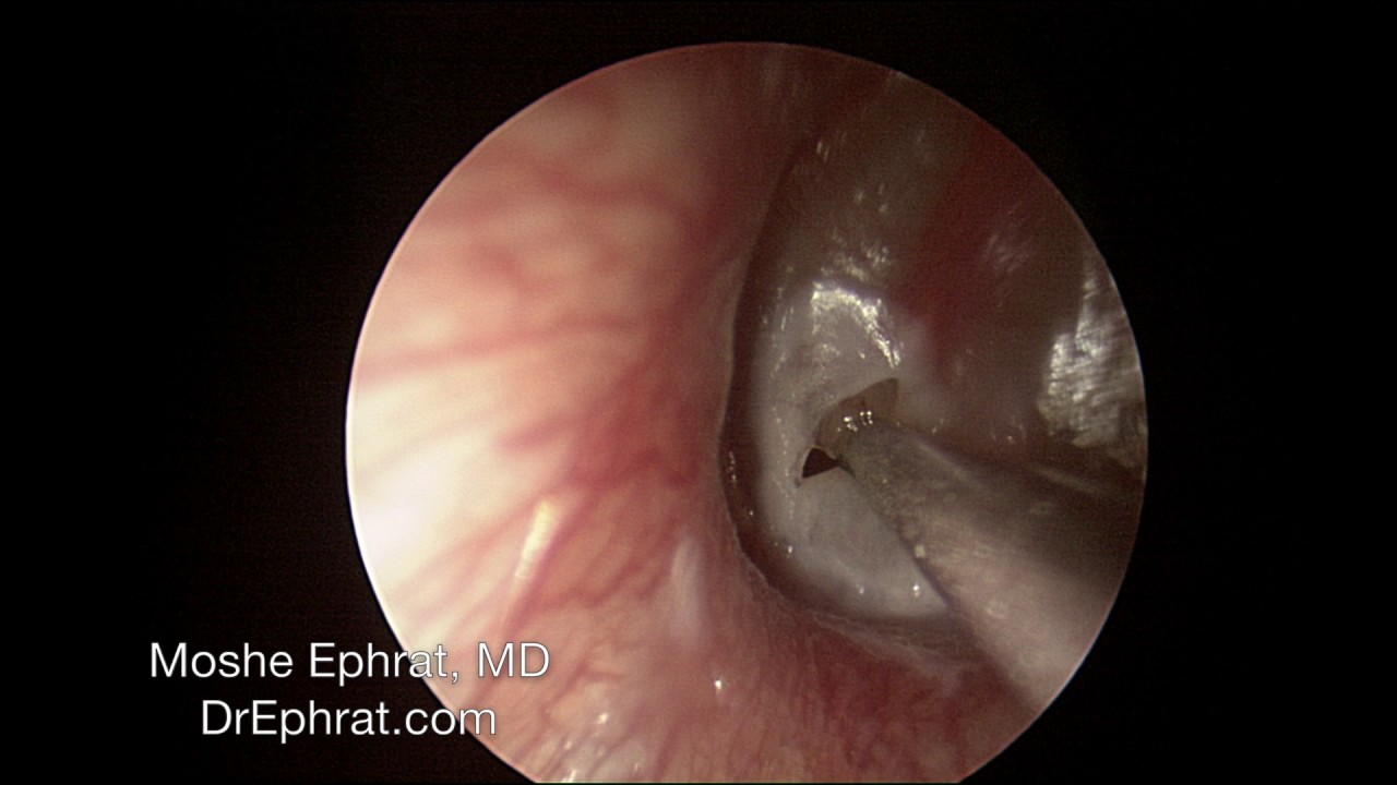 How to drain ear fluid